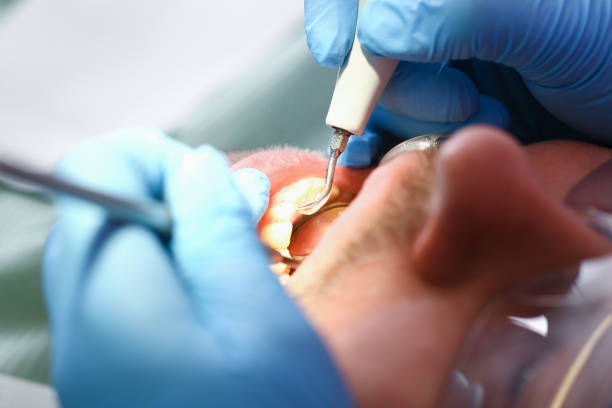 Best Emergency Tooth Extraction in Roslyn, NY